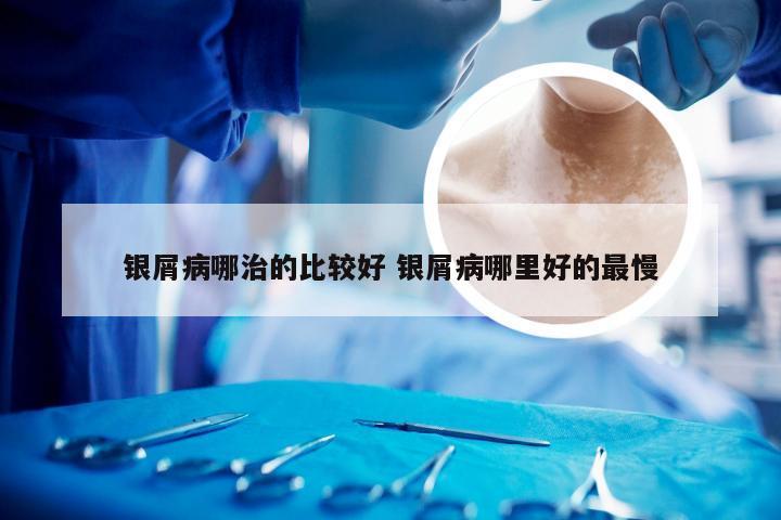 银屑病哪治的比较好 银屑病哪里好的最慢