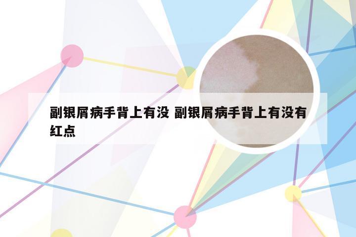 副银屑病手背上有没 副银屑病手背上有没有红点
