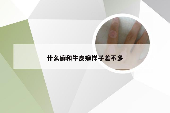 什么癣和牛皮癣样子差不多