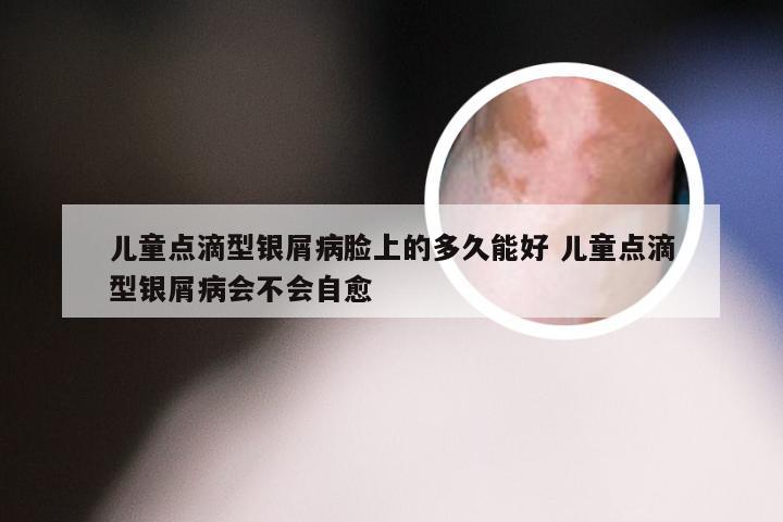 儿童点滴型银屑病脸上的多久能好 儿童点滴型银屑病会不会自愈