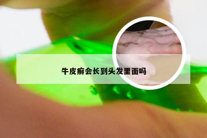 牛皮癣会长到头发里面吗