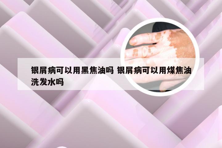 银屑病可以用黑焦油吗 银屑病可以用煤焦油洗发水吗