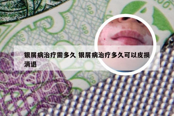 银屑病治疗需多久 银屑病治疗多久可以皮损消退