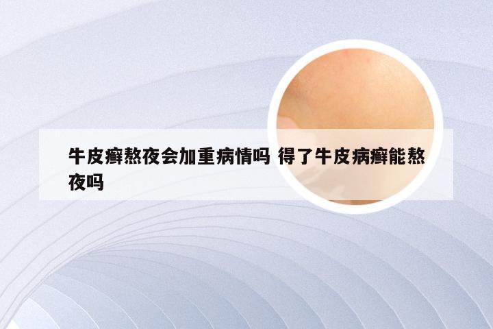 牛皮癣熬夜会加重病情吗 得了牛皮病癣能熬夜吗
