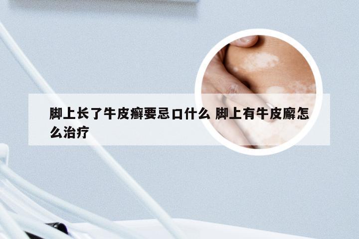 脚上长了牛皮癣要忌口什么 脚上有牛皮廨怎么治疗
