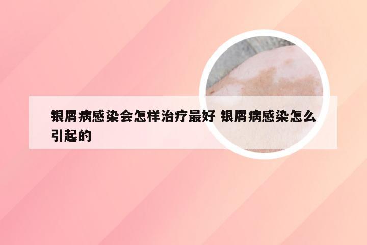 银屑病感染会怎样治疗最好 银屑病感染怎么引起的