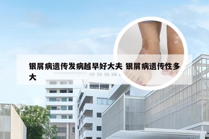 银屑病遗传发病越早好大夫 银屑病遗传性多大