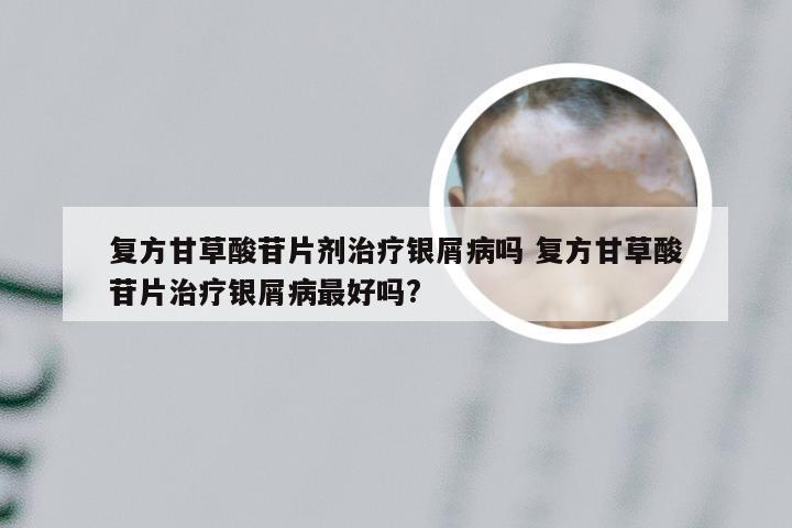 复方甘草酸苷片剂治疗银屑病吗 复方甘草酸苷片治疗银屑病最好吗?