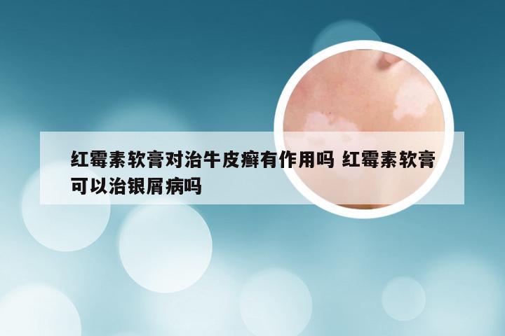 红霉素软膏对治牛皮癣有作用吗 红霉素软膏可以治银屑病吗