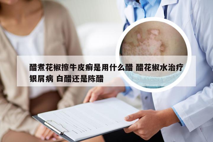 醋煮花椒擦牛皮癣是用什么醋 醋花椒水治疗银屑病 白醋还是陈醋