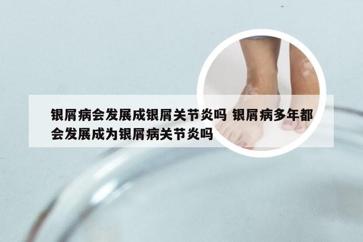 银屑病会发展成银屑关节炎吗 银屑病多年都会发展成为银屑病关节炎吗