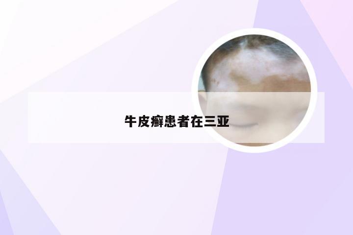 牛皮癣患者在三亚