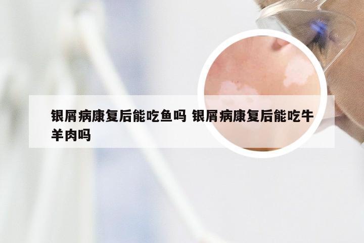 银屑病康复后能吃鱼吗 银屑病康复后能吃牛羊肉吗
