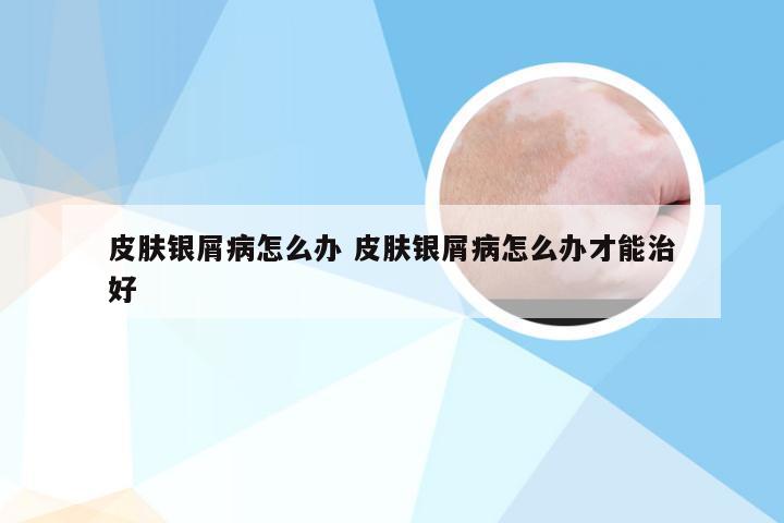 皮肤银屑病怎么办 皮肤银屑病怎么办才能治好