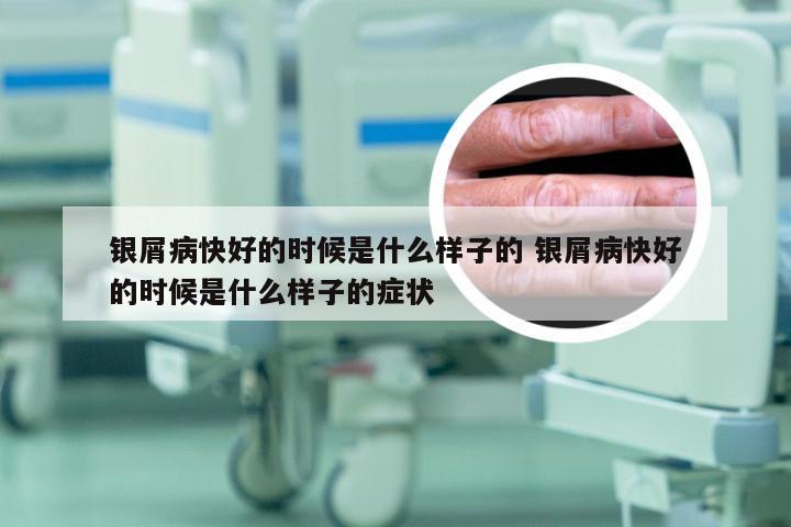 银屑病快好的时候是什么样子的 银屑病快好的时候是什么样子的症状