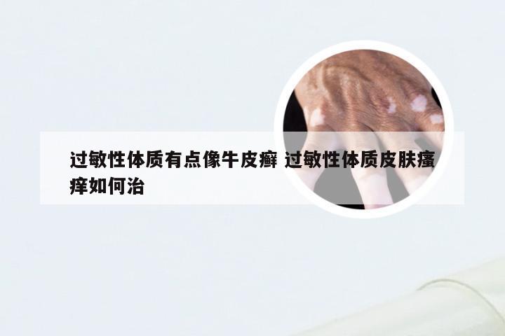 过敏性体质有点像牛皮癣 过敏性体质皮肤瘙痒如何治
