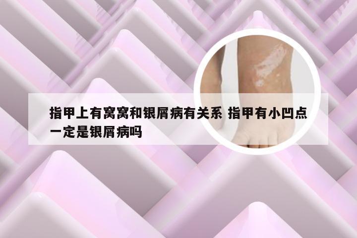 指甲上有窝窝和银屑病有关系 指甲有小凹点一定是银屑病吗
