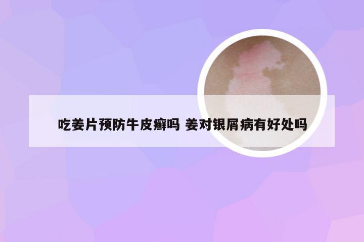吃姜片预防牛皮癣吗 姜对银屑病有好处吗