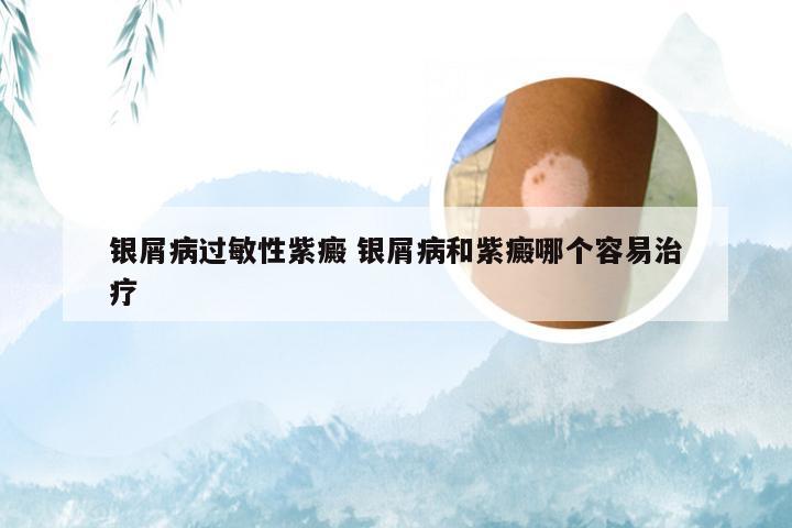 银屑病过敏性紫癜 银屑病和紫癜哪个容易治疗