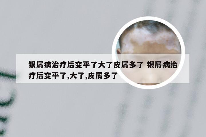 银屑病治疗后变平了大了皮屑多了 银屑病治疗后变平了,大了,皮屑多了