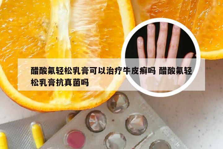 醋酸氟轻松乳膏可以治疗牛皮癣吗 醋酸氟轻松乳膏抗真菌吗
