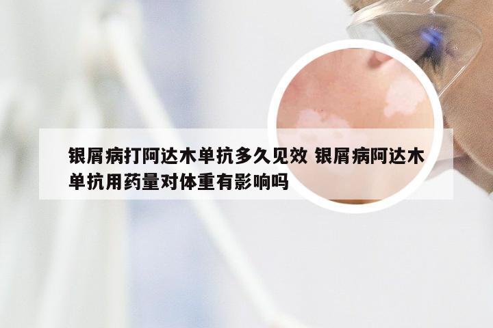 银屑病打阿达木单抗多久见效 银屑病阿达木单抗用药量对体重有影响吗