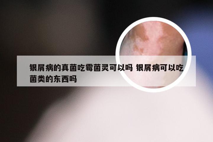 银屑病的真菌吃霉菌灵可以吗 银屑病可以吃菌类的东西吗