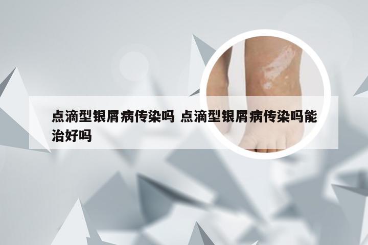 点滴型银屑病传染吗 点滴型银屑病传染吗能治好吗