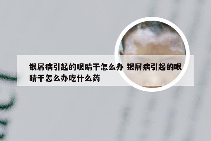 银屑病引起的眼睛干怎么办 银屑病引起的眼睛干怎么办吃什么药