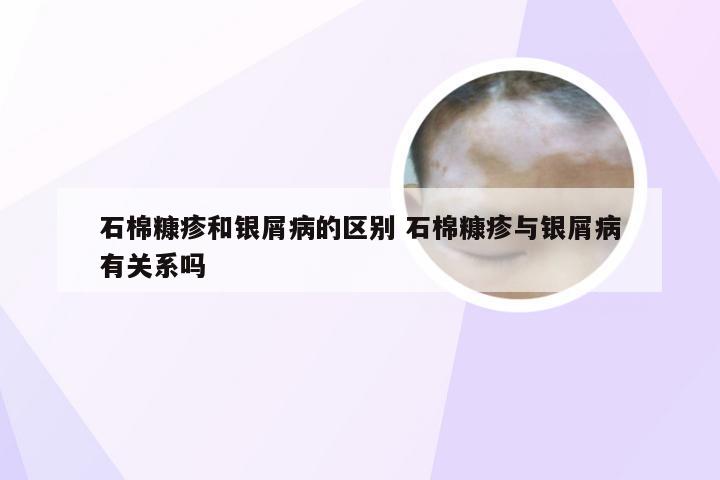 石棉糠疹和银屑病的区别 石棉糠疹与银屑病有关系吗