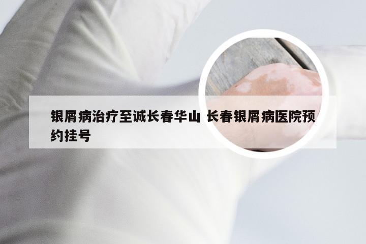 银屑病治疗至诚长春华山 长春银屑病医院预约挂号