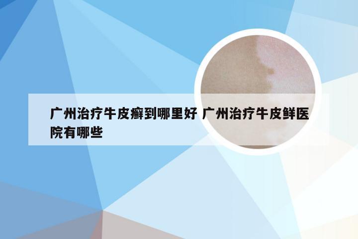 广州治疗牛皮癣到哪里好 广州治疗牛皮鲜医院有哪些