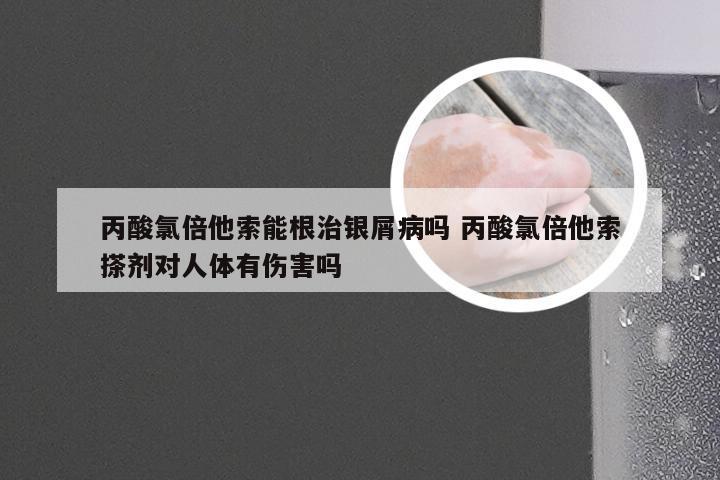 丙酸氯倍他索能根治银屑病吗 丙酸氯倍他索搽剂对人体有伤害吗