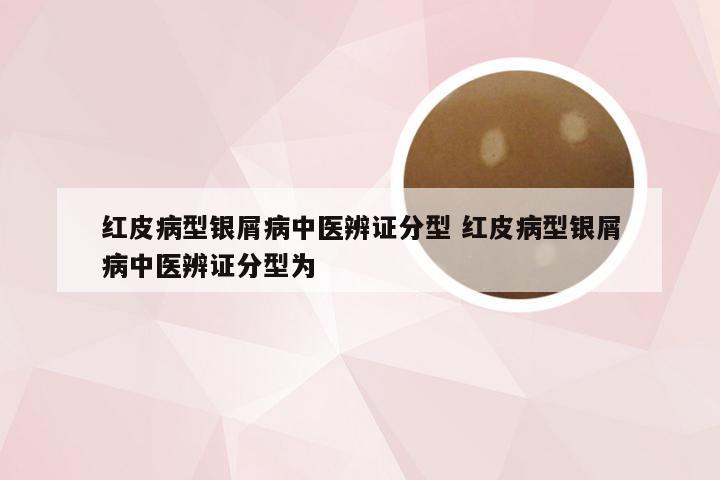 红皮病型银屑病中医辨证分型 红皮病型银屑病中医辨证分型为
