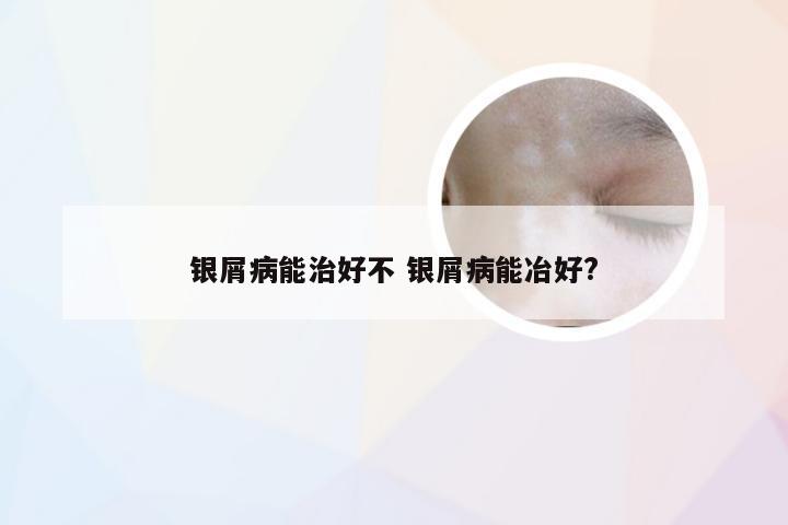 银屑病能治好不 银屑病能冶好?