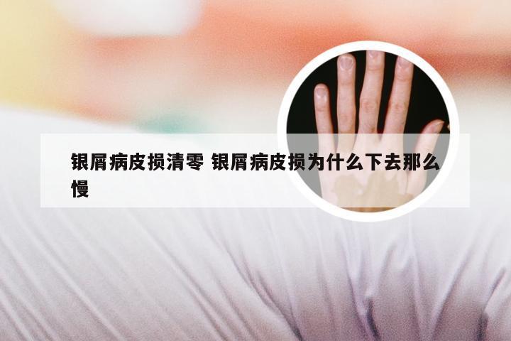 银屑病皮损清零 银屑病皮损为什么下去那么慢