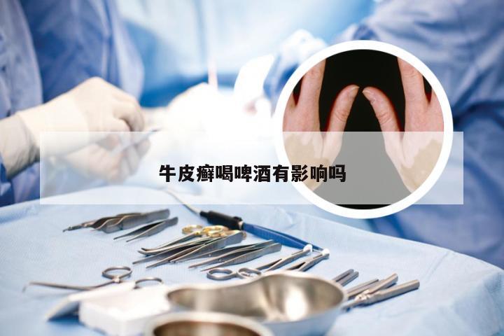 牛皮癣喝啤酒有影响吗
