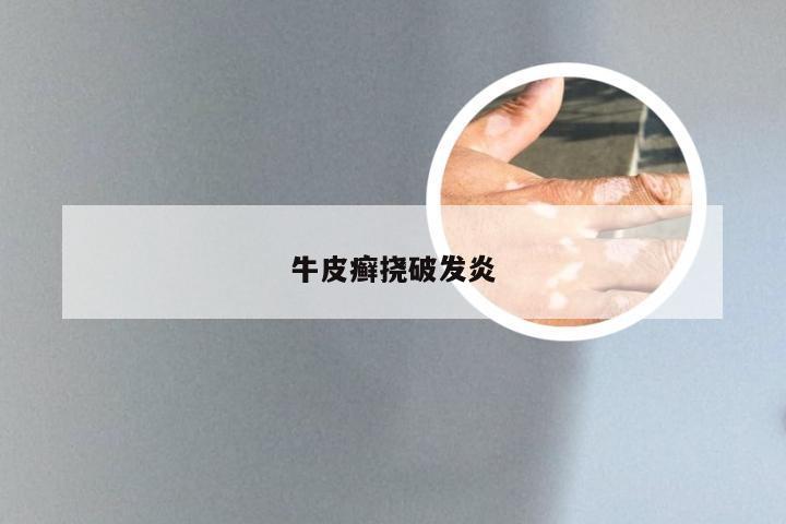 牛皮癣挠破发炎