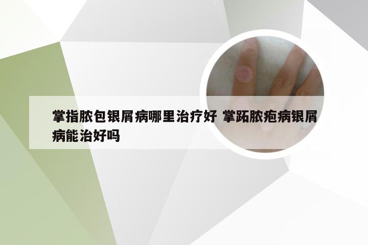 掌指脓包银屑病哪里治疗好 掌跖脓疱病银屑病能治好吗