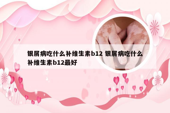 银屑病吃什么补维生素b12 银屑病吃什么补维生素b12最好