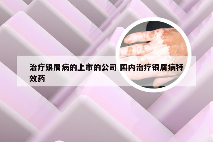 治疗银屑病的上市的公司 国内治疗银屑病特效药