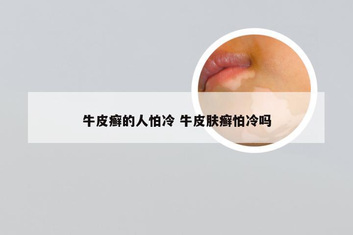 牛皮癣的人怕冷 牛皮肤癣怕冷吗