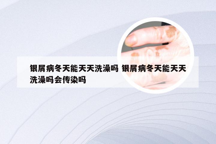 银屑病冬天能天天洗澡吗 银屑病冬天能天天洗澡吗会传染吗