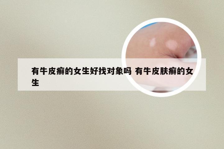 有牛皮癣的女生好找对象吗 有牛皮肤癣的女生