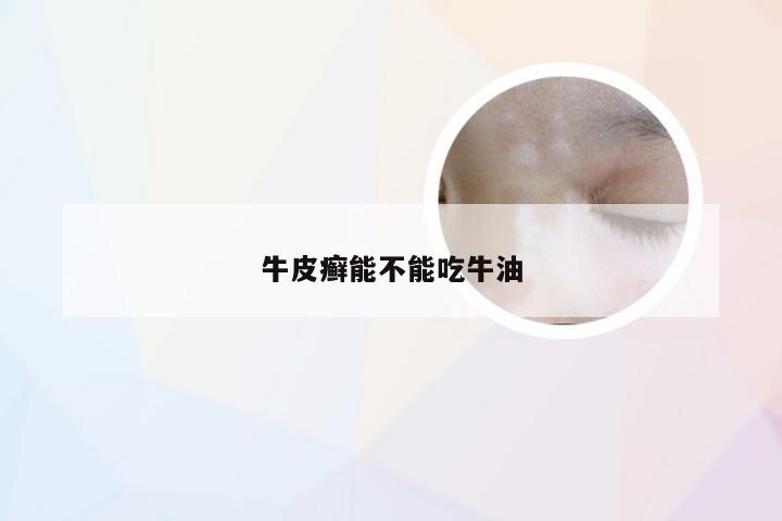 牛皮癣能不能吃牛油