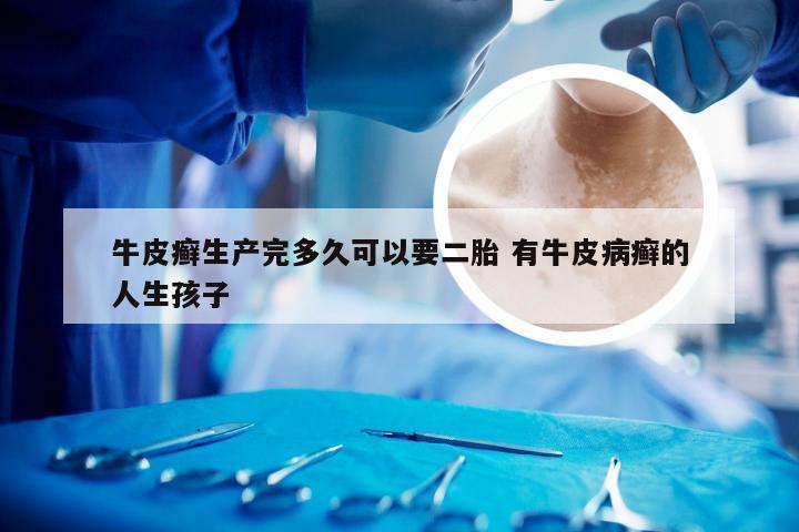 牛皮癣生产完多久可以要二胎 有牛皮病癣的人生孩子