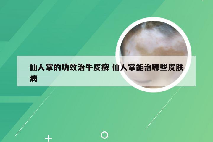 仙人掌的功效治牛皮癣 仙人掌能治哪些皮肤病