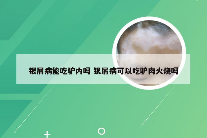 银屑病能吃驴内吗 银屑病可以吃驴肉火烧吗