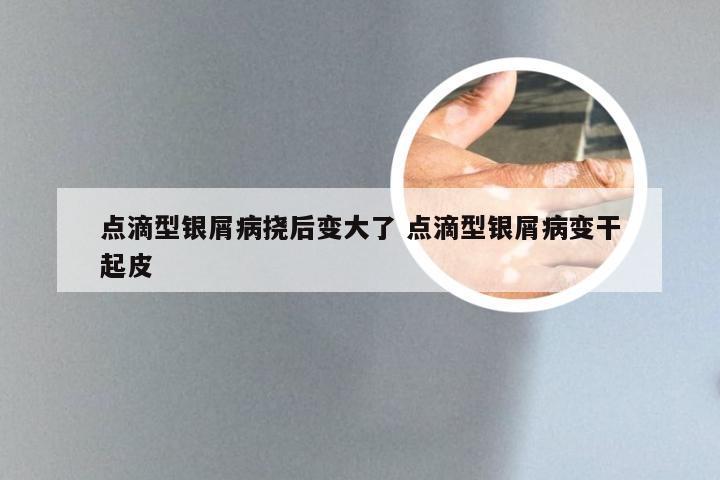 点滴型银屑病挠后变大了 点滴型银屑病变干起皮