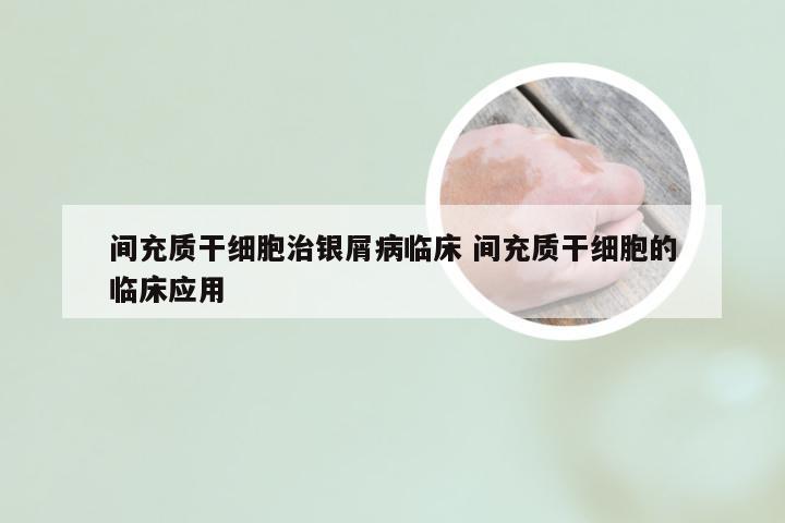 间充质干细胞治银屑病临床 间充质干细胞的临床应用
